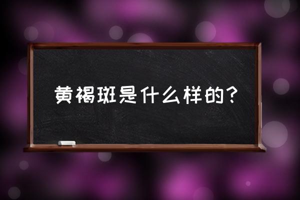 黄褐斑是什么样的形状 黄褐斑是什么样的？