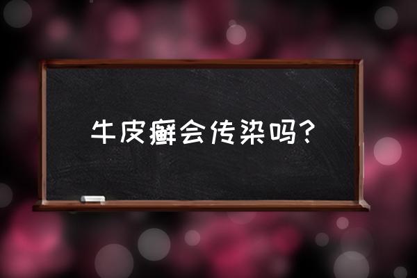 牛皮癣传染么 牛皮癣会传染吗？