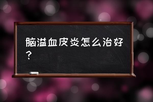 面部脂溢性皮炎反复复发怎么治 脑溢血皮炎怎么治好？